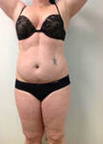 Verju LASER: Liposuccion NON CHIRURGICALE -11,43 cm en 2 semaines ! – Image 6