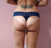 Verju LASER: Liposuccion NON CHIRURGICALE -11,43 cm en 2 semaines ! – Image 2