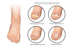 L'infection commence par une tache blanche ou jaune sous le bout de l'ongle et, à mesure qu'elle s'étend plus profondément dans l'ongle, elle provoque une décoloration disgracieuse et potentiellement douloureuse de l'ongle, un épaississement et le développement de bords effrités.