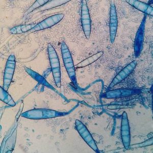 L'onychomycose des ongles, ou infection fongique, est généralement causée par un champignon appelé dermatophytes,