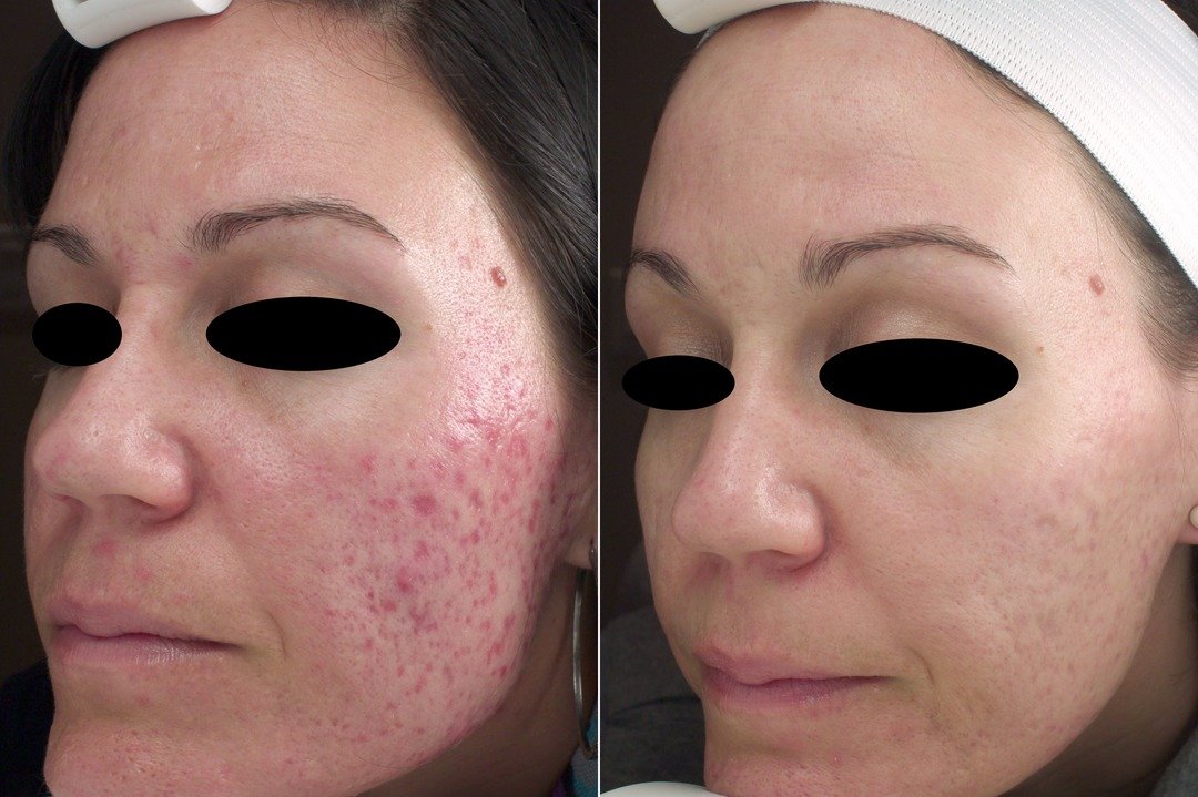 Traitement de l'ACNÉ au LASER en seulement 2 semaines – Image 2